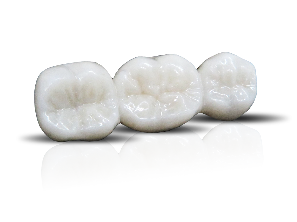 Full-Zirconia-Bridge